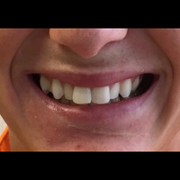 6 Month Braces 2 before